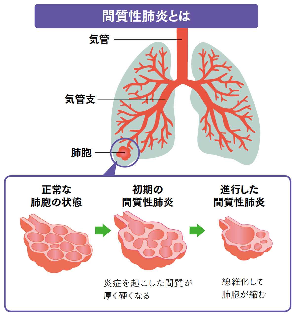 炎症 性 変化 と は 肺